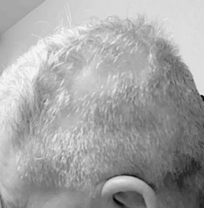 My personal side effects of COVID vaccine